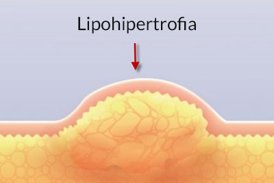 lipohipertrofia